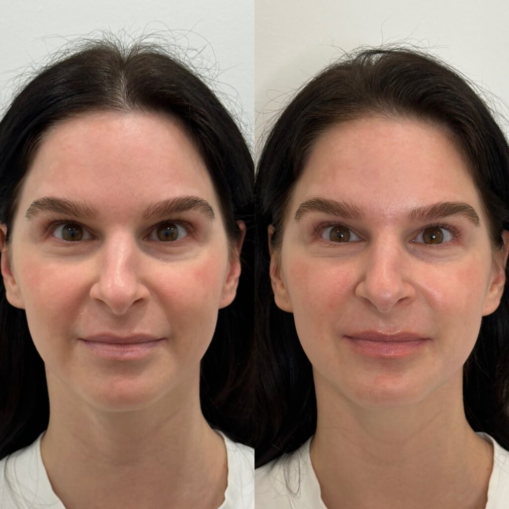before and after sculptra treatment