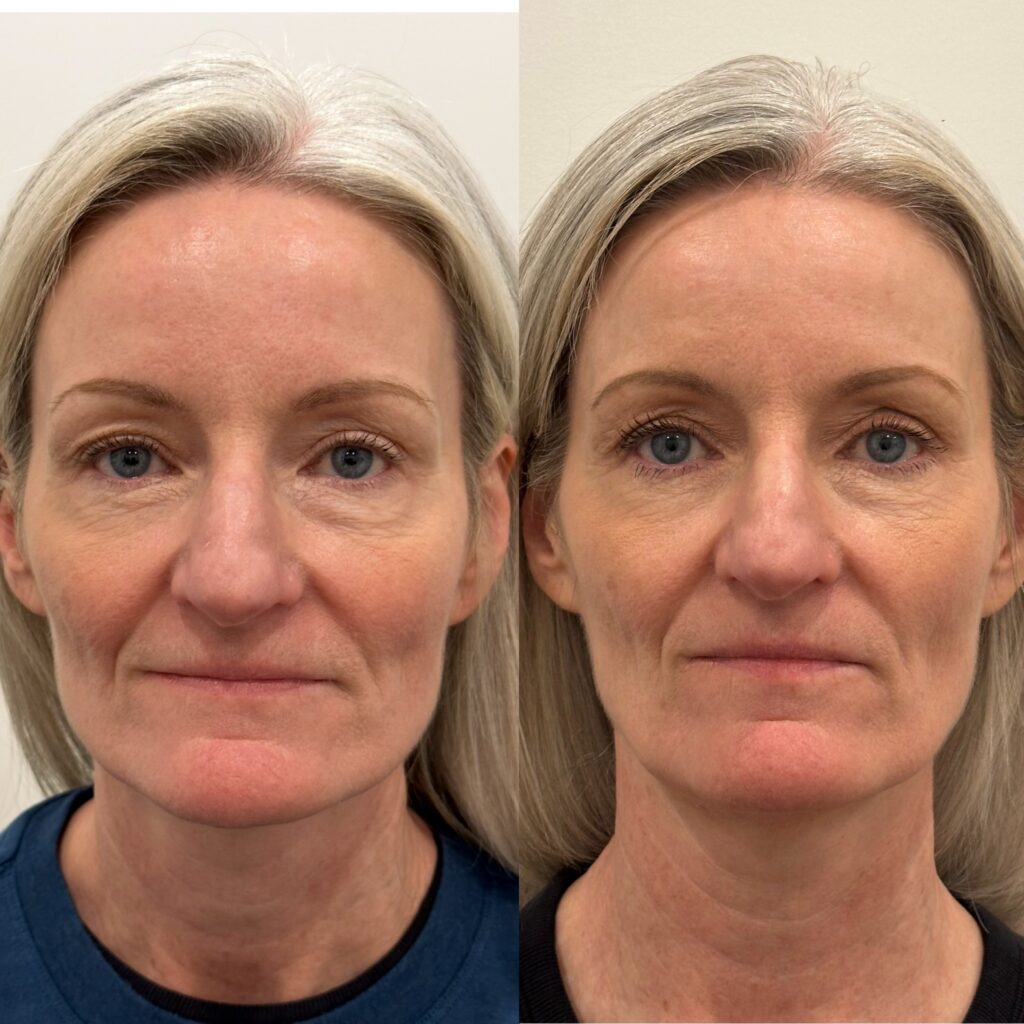 before and after sculptra treatment