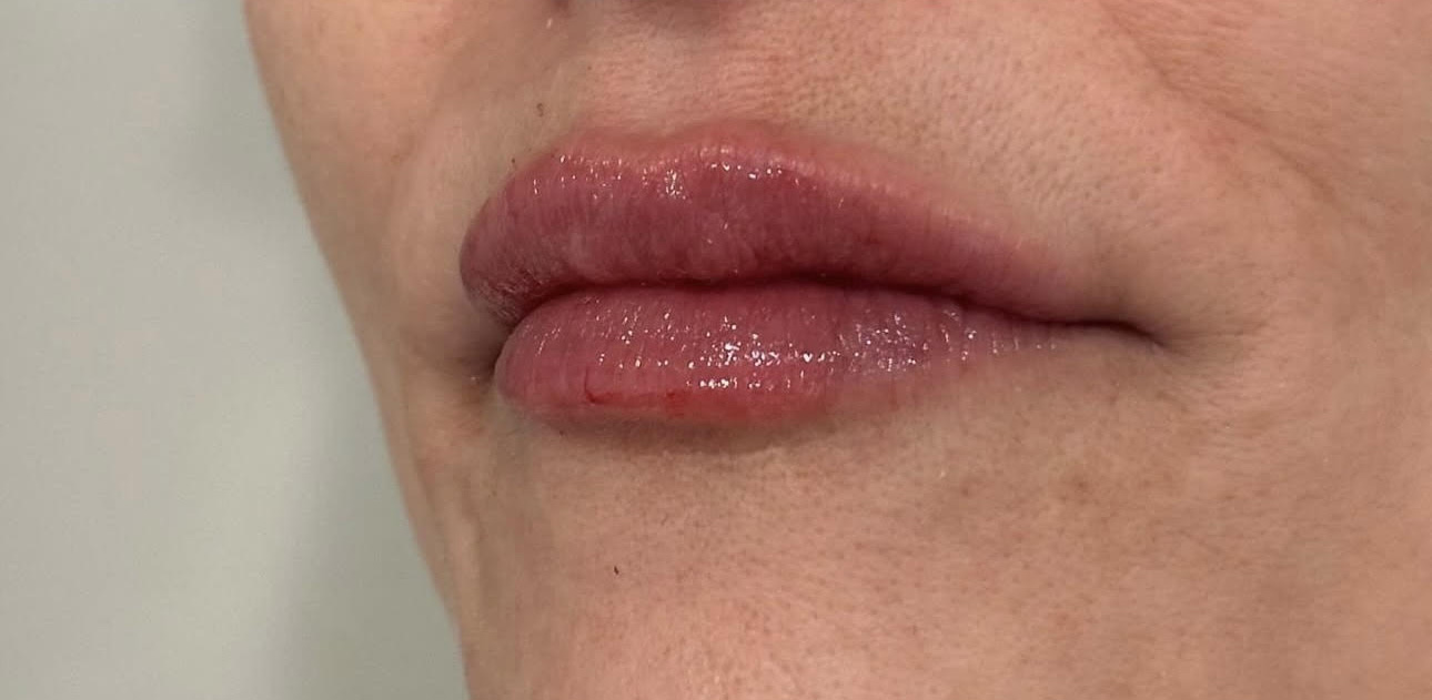 lip filler after photo