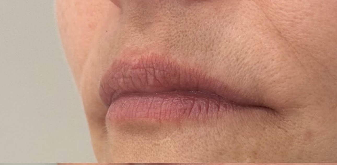 lip filler before photo