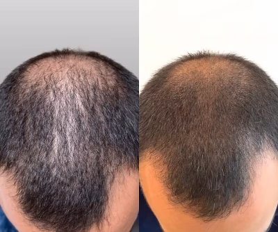Organic-Glow-Medical-Aesthetics-Kelowna-keravive-scalp-treatment-before-and-after (1) (1) Organic-Glow-Medical-Aesthetics-Kelowna-keravive-scalp-treatment-before-and-after (1) (1)