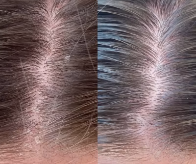 Organic-Glow-Medical-Aesthetics-Kelowna-keravive-scalp-treatment-before-and-after (2)_edit Organic-Glow-Medical-Aesthetics-Kelowna-keravive-scalp-treatment-before-and-after (2)_edit