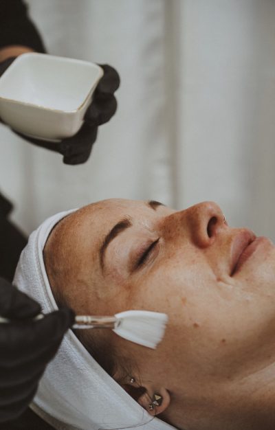 woman receiving chemical peel treatment
